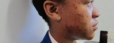 Before Treatment - Active Acne