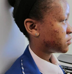 Before Treatment - Active Acne